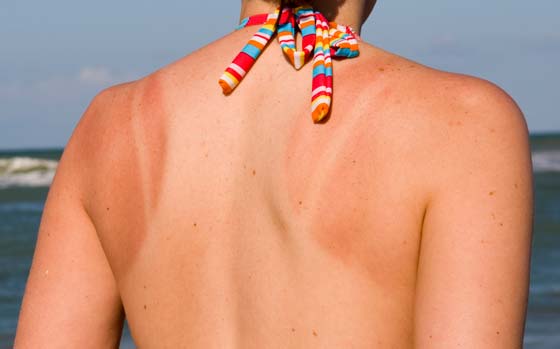 10 (Ten) Best Tips to Avoid Sun Burn During Summer