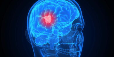 Revolutionizing Brain Cancer Treatment: The Promise of Novel Immunotherapy