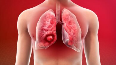 How to deal with lung cancer without letting it affect your daily life