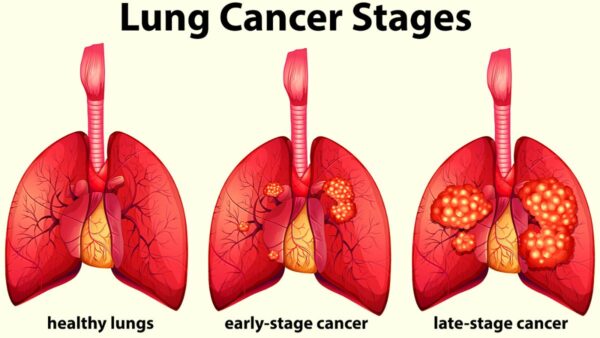 How to deal with lung cancer without letting it affect your daily life