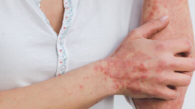 Moyamoya Disease - Symptoms, Treatment, and Causes You Need to Know