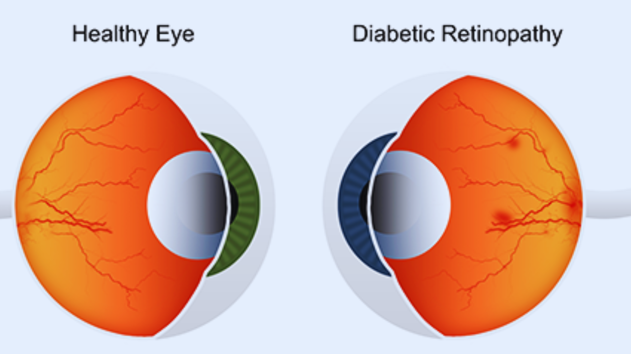 Navigating Life with Low Vision: Strategies and Support 3 Causes of Low Vision